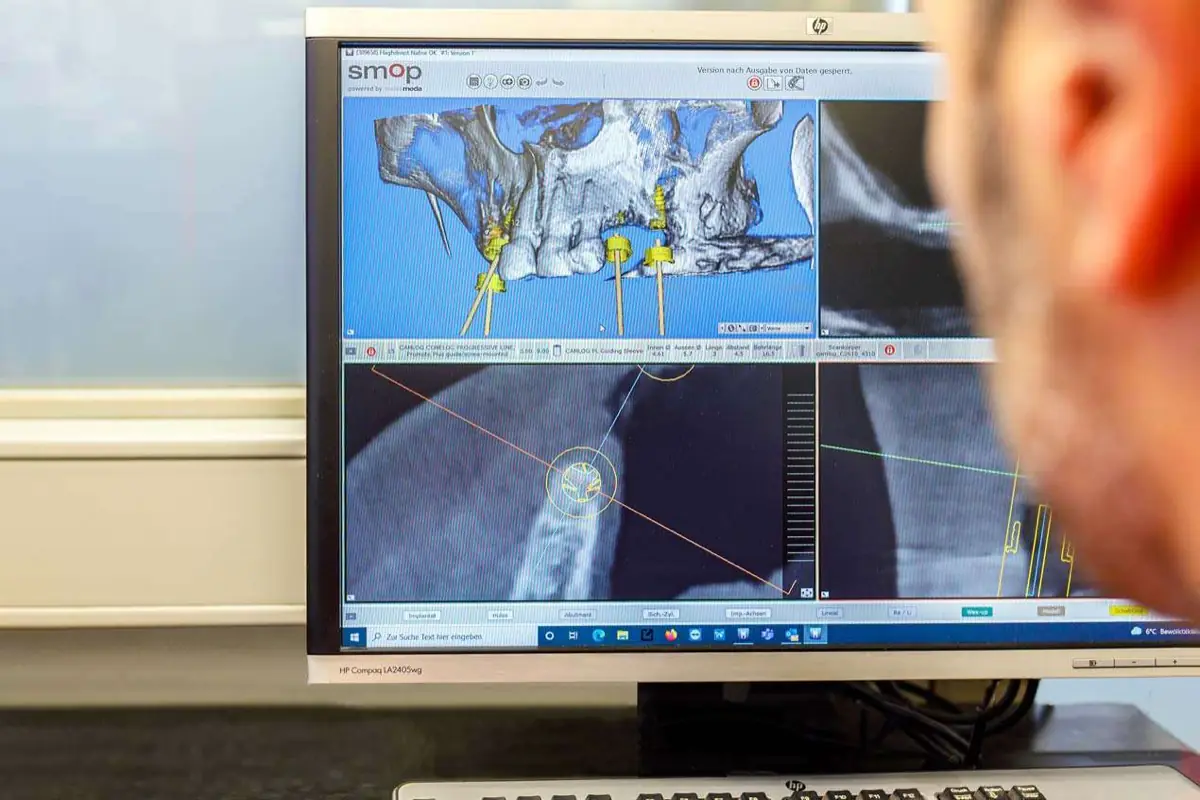 Digitale Implantatplanung am Bildschirm