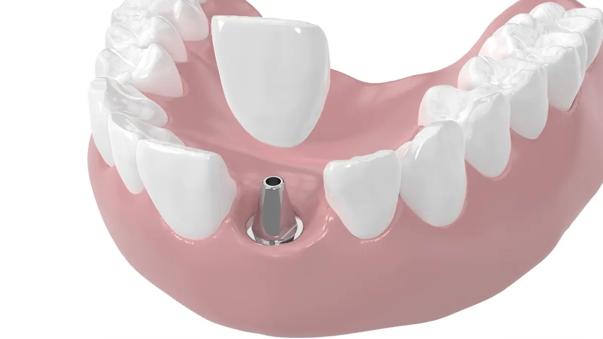 Schaltlücke mit Implantat und natürlichem Zahn